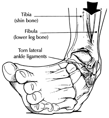 Ankle Injuries