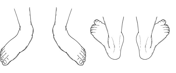 Pediatric and Adult Flatfoot