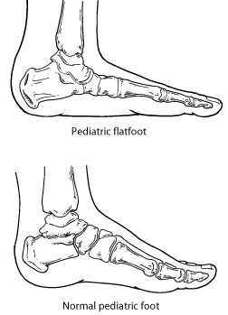 Pediatric and Adult Flatfoot