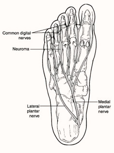 Pediatric and Adult Flatfoot